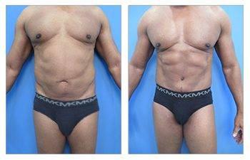 high definition liposuction high definition liposuction