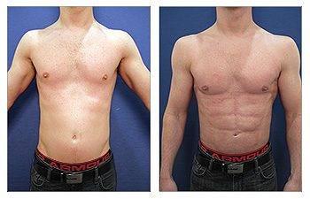 Tummy tuck before and after with male breast surgery recovery. Tummy tuck before and after with male breast surgery recovery.