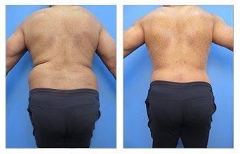 Male Back Liposuction Male Back Liposuction
