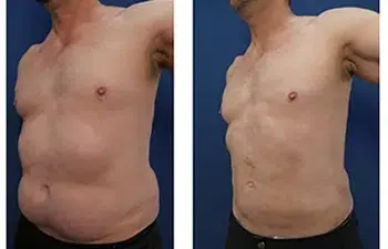 PAH-revisiDefinitive Treatment of PAH Paradoxical Adipose Hyperplasiaon-2 PAH-revisiDefinitive Treatment of PAH Paradoxical Adipose Hyperplasiaon-2