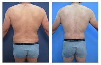 A woman's butt before and after a Mini Mommy Makeover, which includes a tummy tuck. A woman's butt before and after a Mini Mommy Makeover, which includes a tummy tuck.