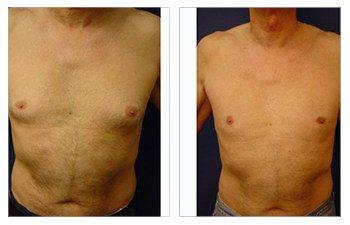 Gynecomastia Gynecomastia