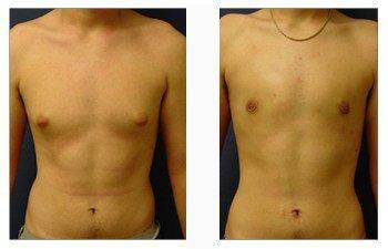 male breast surgery patient 4 front view male breast surgery patient 4 front view