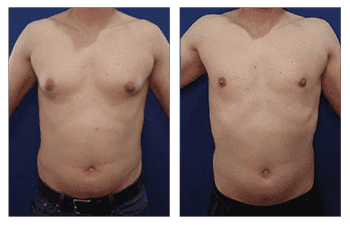 edited gynecomastia-patient-12-front edited gynecomastia-patient-12-front