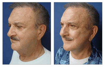 Face Lift and Neck Face Lift and Neck