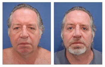 A man with a beard before and after a rejuvenating facelift. A man with a beard before and after a rejuvenating facelift.