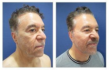 A woman's breasts undergo a remarkable transformation through the best breast lift revision procedure. A woman's breasts undergo a remarkable transformation through the best breast lift revision procedure.