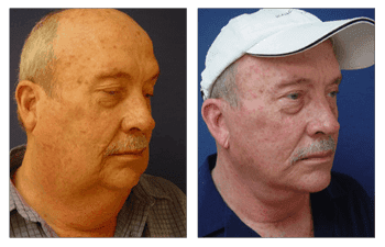 Face lift and neck Face lift and neck