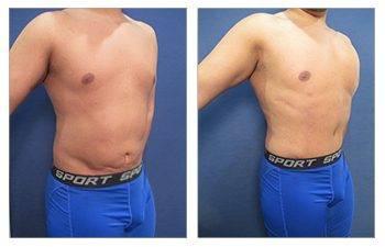 Viora External Radio-Frequency to Treat Hyper-Inflammatory Fibrosis Viora External Radio-Frequency to Treat Hyper-Inflammatory Fibrosis