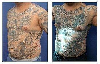 HD Liposuction + Abdominal Etching — #SS093 HD Liposuction + Abdominal Etching — #SS093