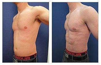 Liposuction — #SS096 Liposuction — #SS096