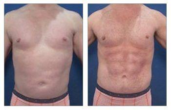 How Much Does Abdominal Etching Cost?