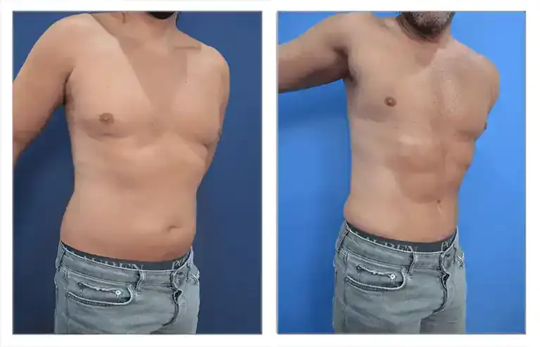 360 Tummy Tuck before and after. 360 Tummy Tuck before and after.