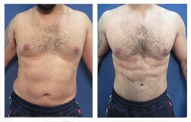 Take advantage of our Virtual Cosmetic Surgery Consult to view amazing tummy tuck before and after transformations. Take advantage of our Virtual Cosmetic Surgery Consult to view amazing tummy tuck before and after transformations.