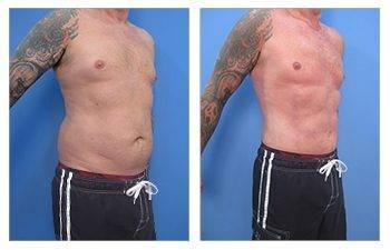 What is VASER Liposuction? What is VASER Liposuction?