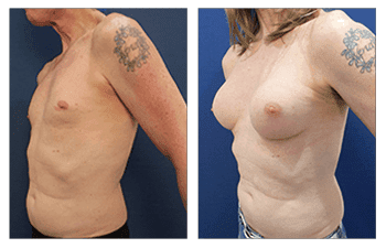 Transgender-male-to-female-breast-surgery-1 Transgender-male-to-female-breast-surgery-1
