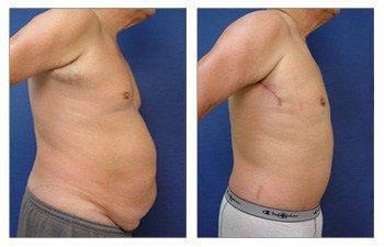 reducing abdominal girth with a tummy tuck Newport Beach reducing abdominal girth with a tummy tuck Newport Beach