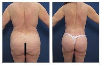 Maximizing Buttock Augmentation Maximizing Buttock Augmentation