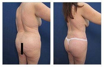 Maximizing Buttock Augmentation — patient photo Maximizing Buttock Augmentation — patient photo