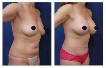 Mini Tummy Tuck Cost Mini Tummy Tuck Cost