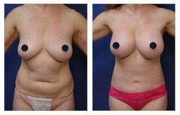 Mini Tummy Tuck Cost Mini Tummy Tuck Cost