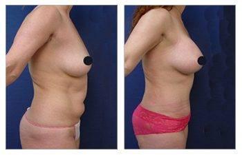 Mini Tummy Tuck Cost Mini Tummy Tuck Cost