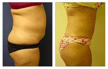 Mini Tummy Tuck Reviews Mini Tummy Tuck Reviews