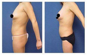 Before and after pictures of a woman's mini tummy tuck, showcasing the scar transformation. Before and after pictures of a woman's mini tummy tuck, showcasing the scar transformation.