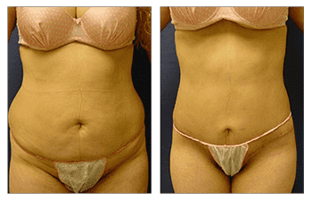mini tummy tuck patient 8 before and after mini tummy tuck patient 8 before and after