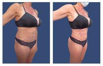 Mini Tummy Tuck — #SS072 Mini Tummy Tuck — #SS072