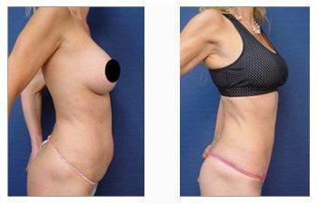 tummy tuck patient 1 right view tummy tuck patient 1 right view