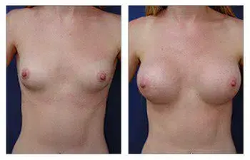 Minimizing incision line prominence during breast augmentation, the appearance of a woman's breast is showcased before and after surgery. Minimizing incision line prominence during breast augmentation, the appearance of a woman's breast is showcased before and after surgery.