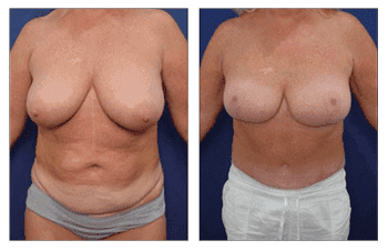 orange county mommy makeover patient patient 23 front