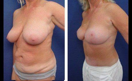 orange county mommy makeover patient patient 23 front left orange county mommy makeover patient patient 23 front left