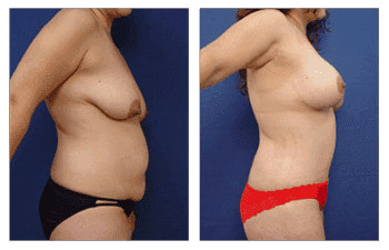 mommy makeover patient 24 right view mommy makeover patient 24 right view