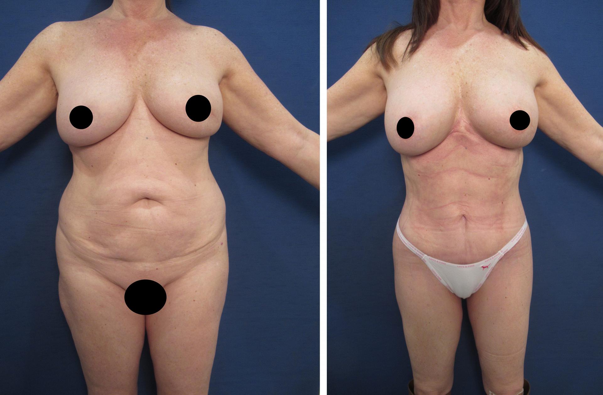 Mommy Makeover Revision Mommy Makeover Revision