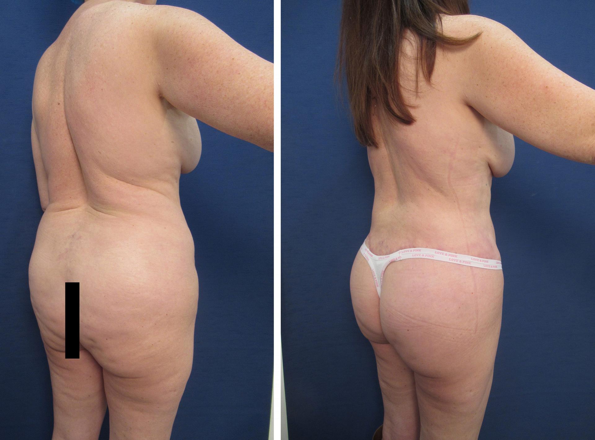 Mommy Makeover Revision Mommy Makeover Revision