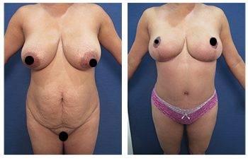 Mommy Makeover To Correct Diastasis Recti Mommy Makeover To Correct Diastasis Recti