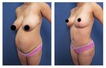 Mommy Makeover To Correct Diastasis Recti Mommy Makeover To Correct Diastasis Recti