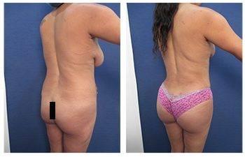Mommy Makeover To Correct Diastasis Recti Mommy Makeover To Correct Diastasis Recti