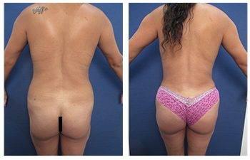 Mommy Makeover To Correct Diastasis Recti Mommy Makeover To Correct Diastasis Recti