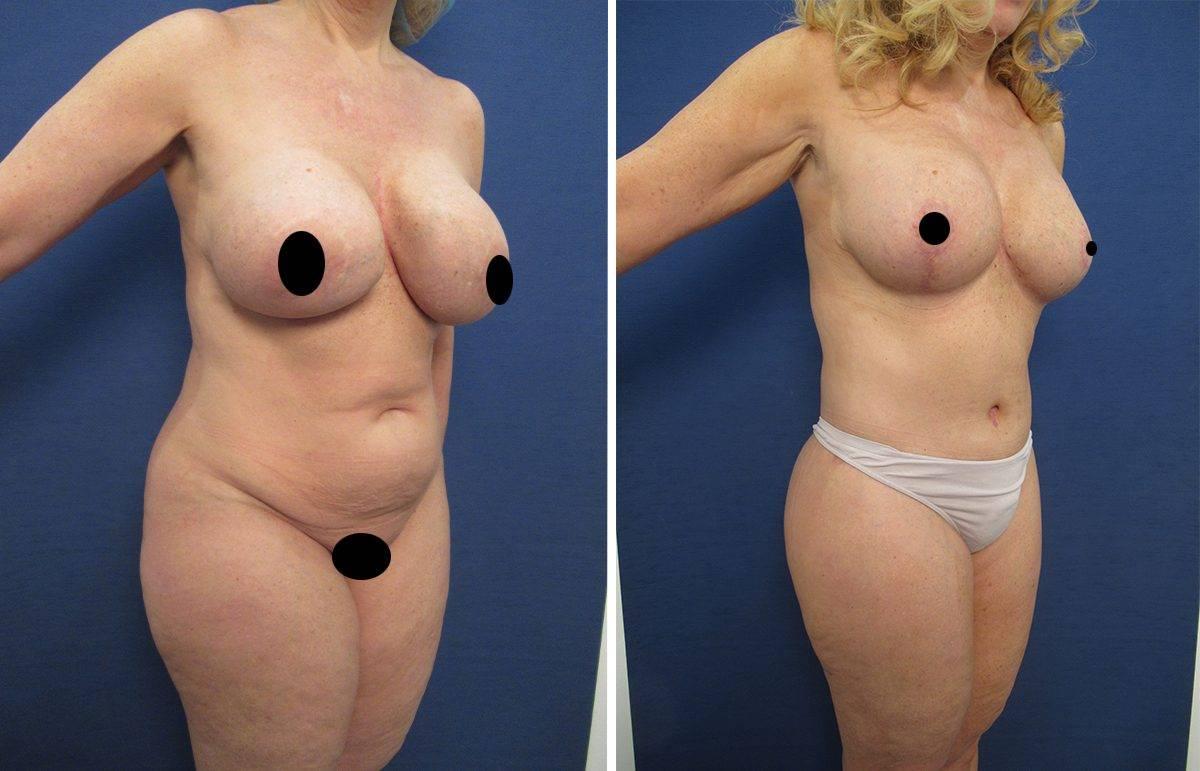 Mommy Makeover To Eliminate Flank Fullness Mommy Makeover To Eliminate Flank Fullness