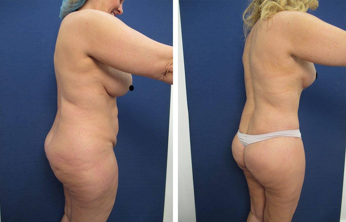 Mommy Makeover To Eliminate Flank Fullness Mommy Makeover To Eliminate Flank Fullness