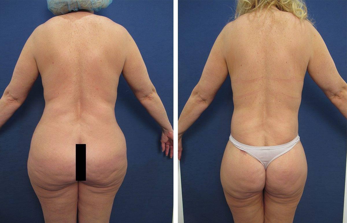 Mommy Makeover To Eliminate Flank Fullness Mommy Makeover To Eliminate Flank Fullness