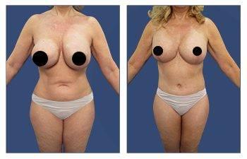 A woman's breasts before and after surgery to eliminate flank fullness. A woman's breasts before and after surgery to eliminate flank fullness.