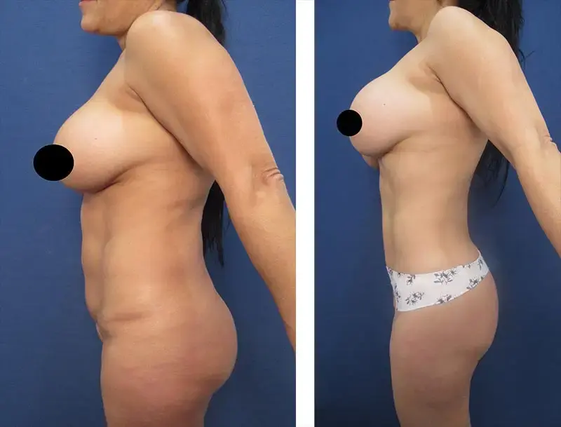 Mommy Makeover To Fix Contour Irregularities Mommy Makeover To Fix Contour Irregularities