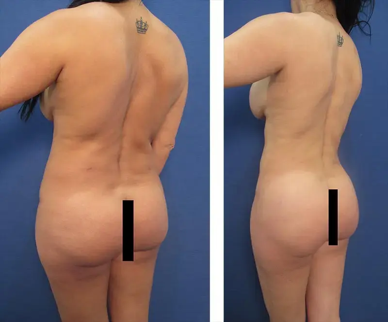 Mommy Makeover To Fix Contour Irregularities Mommy Makeover To Fix Contour Irregularities