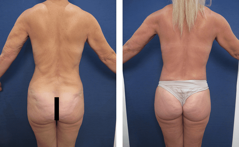 Before and after pictures showcasing a woman's remarkable buttlift transformation. Before and after pictures showcasing a woman's remarkable buttlift transformation.