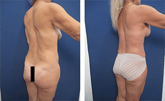 Mommy makeover with tummy tuck and breast lift featuring before and after results. Mommy makeover with tummy tuck and breast lift featuring before and after results.