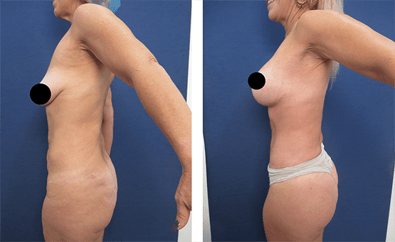 See amazing Mini Tummy tuck before and after transformations in Los Angeles. See amazing Mini Tummy tuck before and after transformations in Los Angeles.